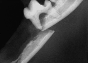 Pathologic Jaw Fracture from Periodontal Disease